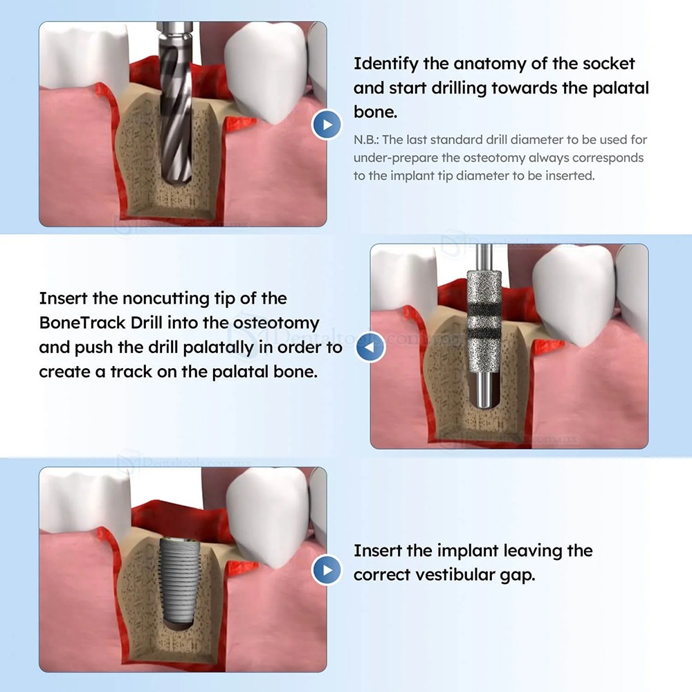 Kit de 4 Piezas FG7604 Fresas para Marcaci&oacute;n &Oacute;sea y Correcci&oacute;n de Cuello en Implantes Dentales